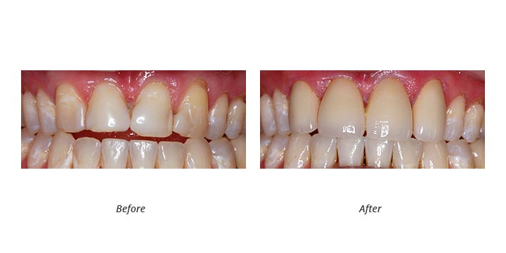 porcelain crowns