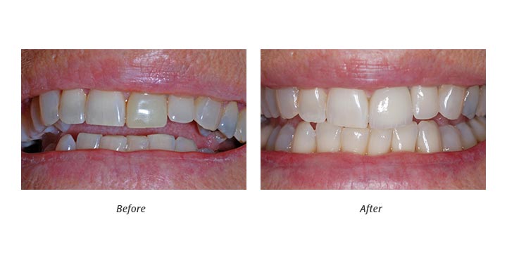 porcelain veneer and whitening